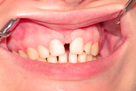 ¿Hay que tratar siempre el frenillo interdental?