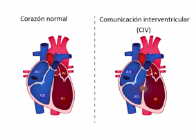 ¿Qué es una comunicación interventricular?¿Qué problemas puede tener? ¿Qué hay que hacer?