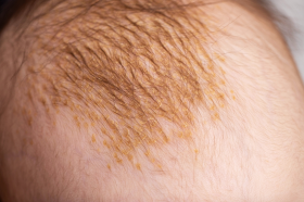 La costra láctea es una forma de dermatitis seborreica que se presenta de forma frecuente en el bebé.