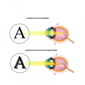 Astigmatismo