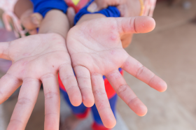 Exantema por enterovirus