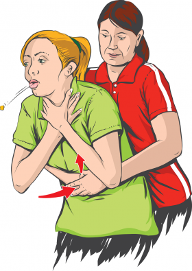 Maniobra de Heimlich