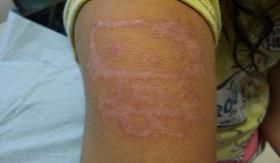 dermatitis por sensibilizacion a henna negra