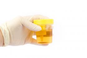 hipercalciuria