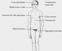 Si necesitas saber de qué se trata un sindrome de Klineffelter, debes leer este artículo.