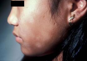 Pitiriasis alba