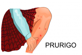 Prúrigo