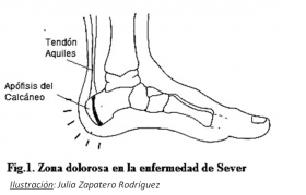 Enfermedad de Sever