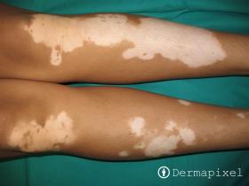 Figura 1. Vitíligo. Fuente: Dermapixel