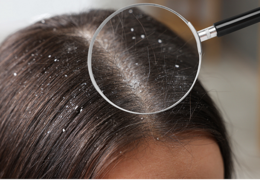 dermatitis-seborreica-leve-del-cuero-cabelludo