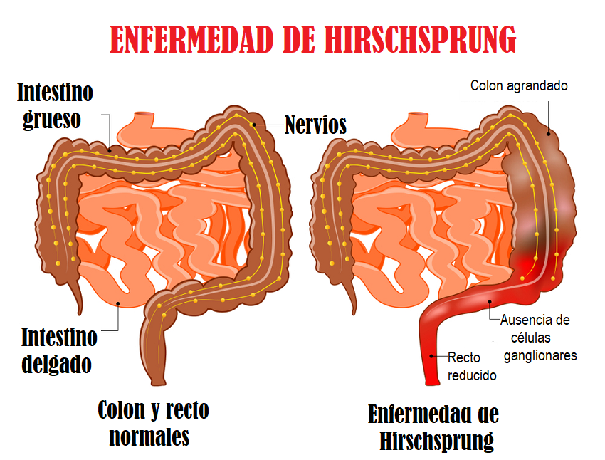 Fisiopatologia De La Enfermedad De Hirschsprung