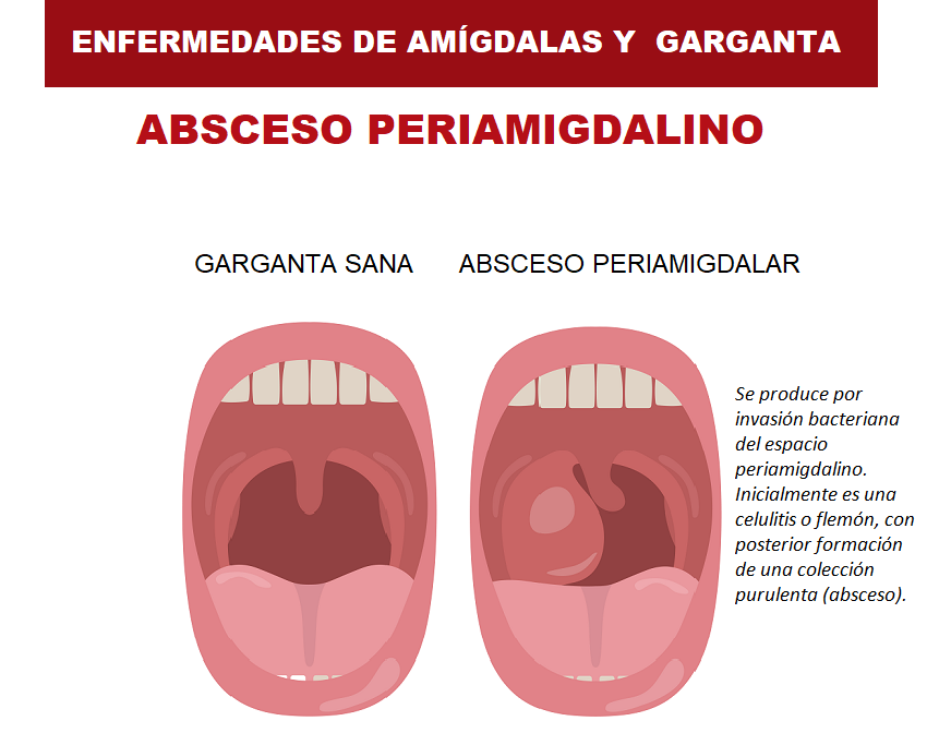 El flemón periamigdalino | Familia y Salud