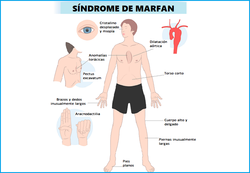 Síndrome de Marfan: la enfermedad del tejido conectivo | Familia y Salud