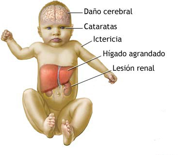 Galactosemia | Familia y Salud