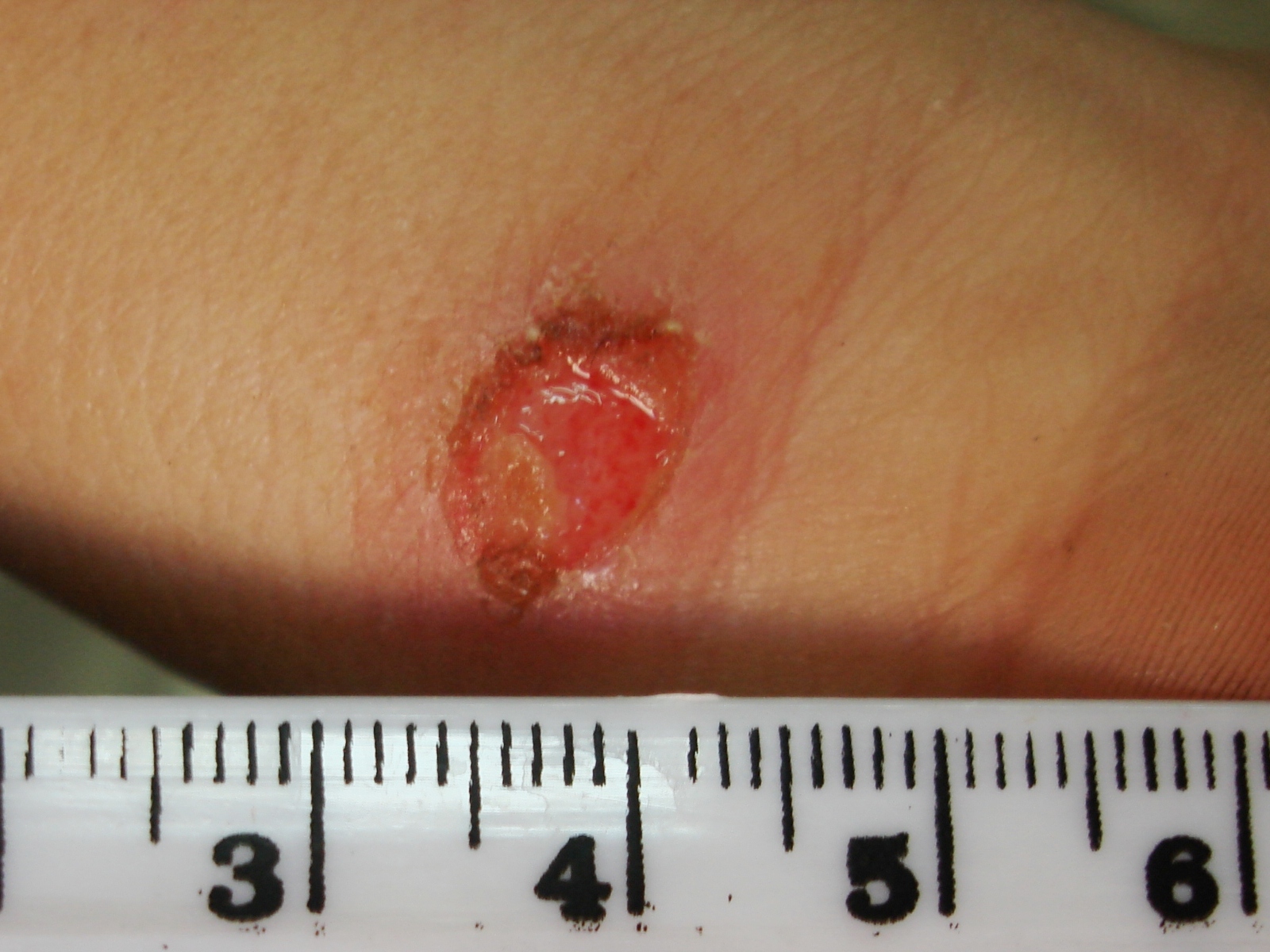 Leishmaniasis: Aquellas moscas infectaban perros y | y Salud