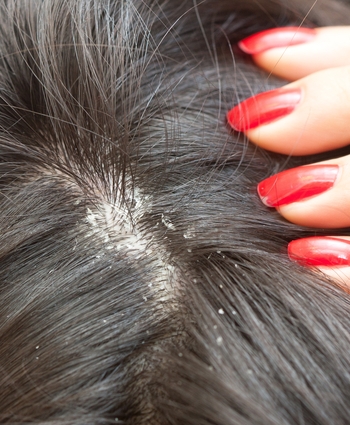 La Caspa En El Pelo. Dermatitis Seborreica Del Cuero Cabelludo