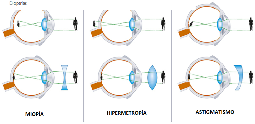 myopia dioptriák