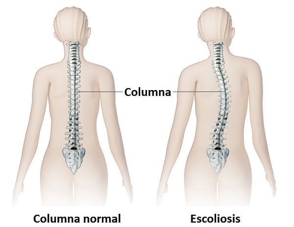 Escoliosis