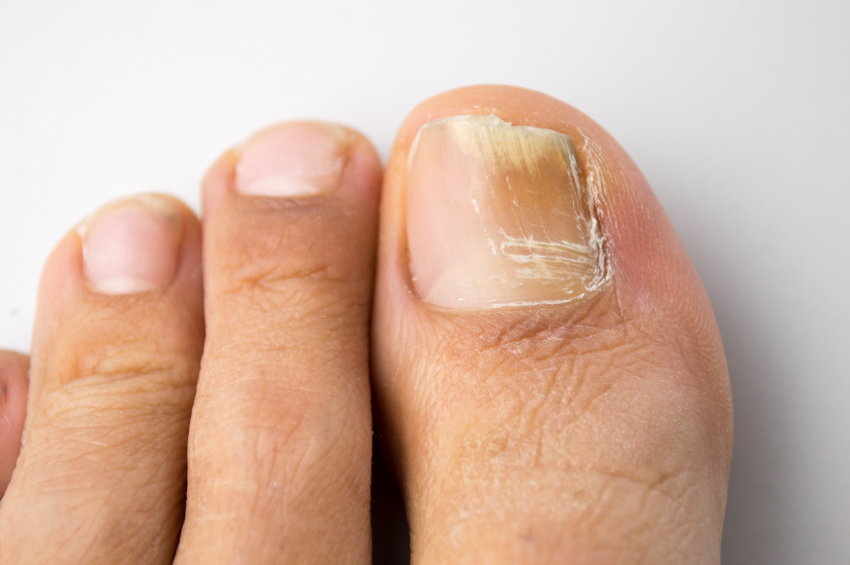 Alerta podológica Los esmaltes permanentes pueden causar hongos en las uñas  de los pies  Actualidad  Cadena SER