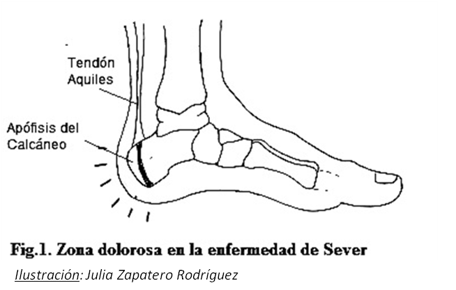 Porque me duele el tendon de aquiles cuando corro