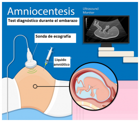 Examen de top amniocentesis