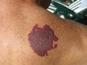 Anomalias Vasculares Hemangiomas Y Malformaciones Vasculares Familia Y Salud