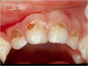 Caries En Los Dientes De Leche Familia Y Salud