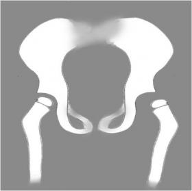 Figura 1. Displasia congénita de cadera 