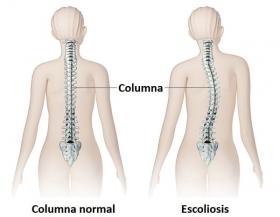 ESCOLIOSIS