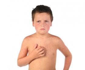 Exantemas Virales En La Infancia Que Son Familia Y Salud