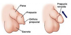 niños
-orificio uretral en punta
del glande
-pene de 3 a 4 cm
-escroto pigmentado y rugoso