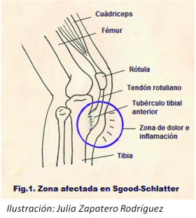 Estoy Creciendo Y Me Duele La Rodilla Enfermedad De Osgood Schlatter Familia Y Salud