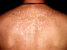 cuerno insecto Inminente Manchas blancas o hipopigmentación en la piel | Familia y Salud