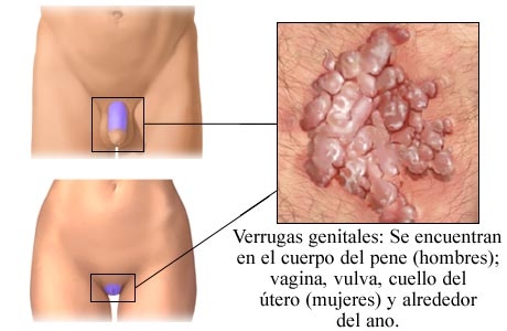 Papiloma en el ano, Verrugas anogenitales por el VPH (Virus Papiloma Humano) hpv szemolcs vegbel