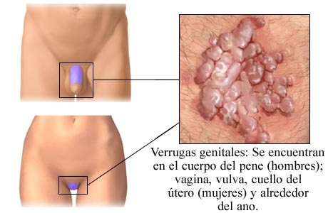 condilomas humanos